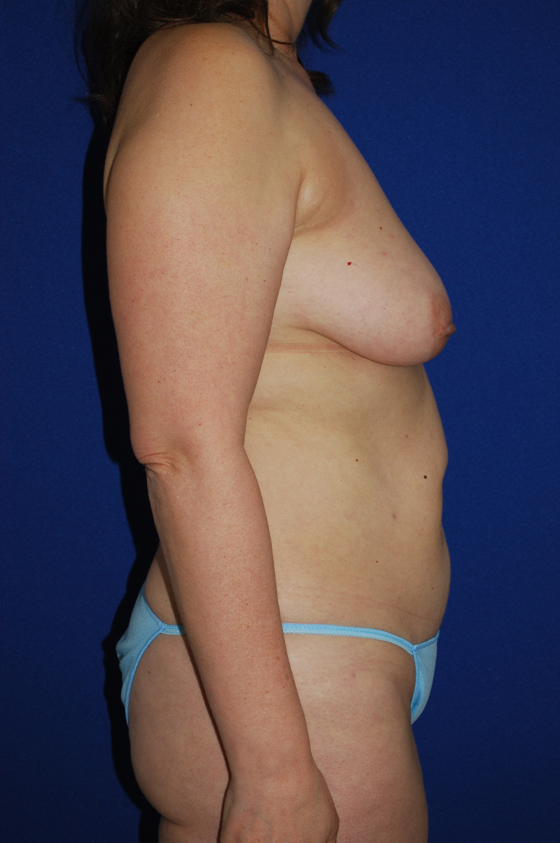 Lift Before and After | Plastic Surgery Institute of Washington