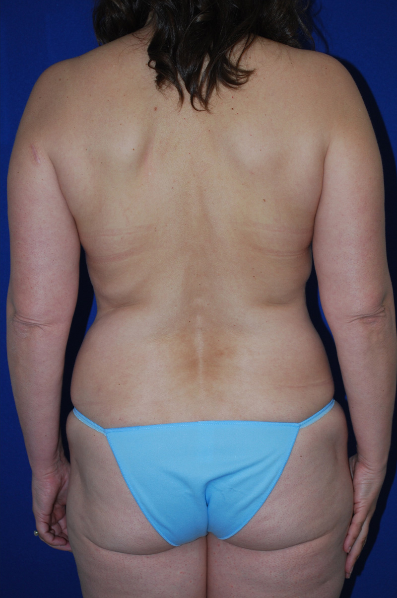 Lift Before and After | Plastic Surgery Institute of Washington