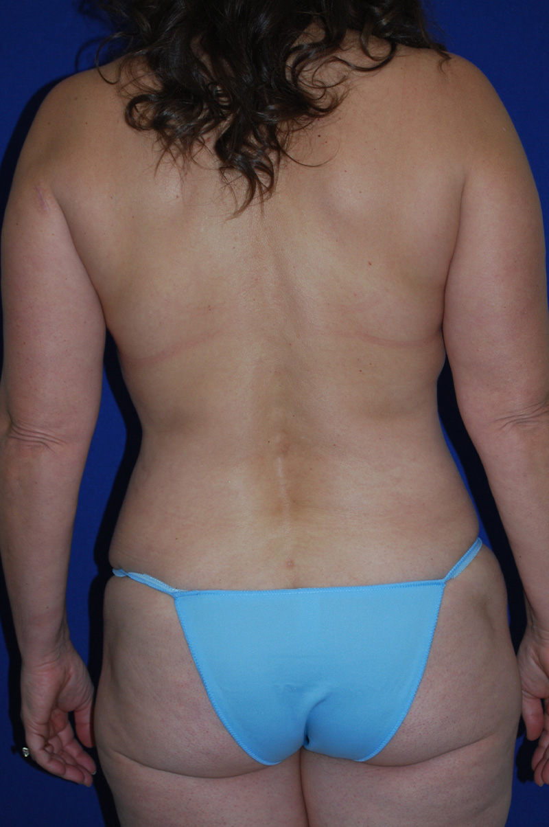 Lift Before and After | Plastic Surgery Institute of Washington