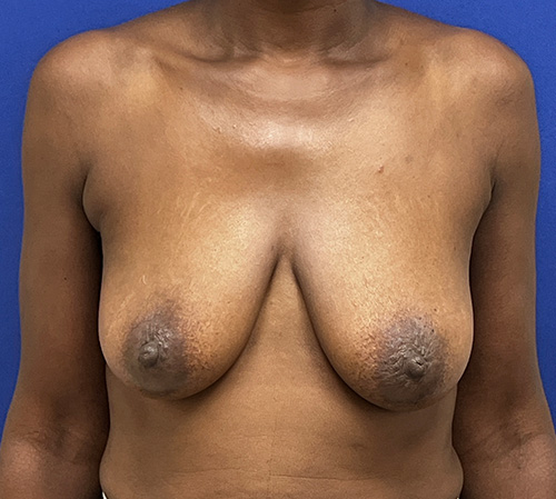 Lift Before and After | Plastic Surgery Institute of Washington