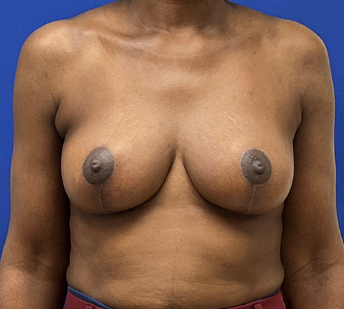 Lift Before and After | Plastic Surgery Institute of Washington