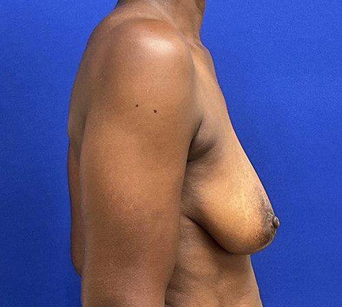 Lift Before and After | Plastic Surgery Institute of Washington