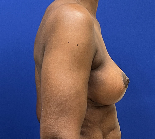 Lift Before and After | Plastic Surgery Institute of Washington