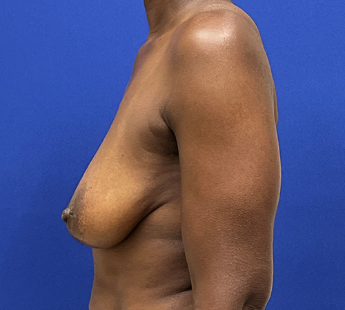 Lift Before and After | Plastic Surgery Institute of Washington