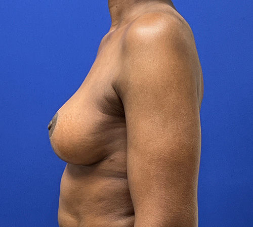 Lift Before and After | Plastic Surgery Institute of Washington