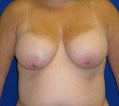 Lift Before and After | Plastic Surgery Institute of Washington