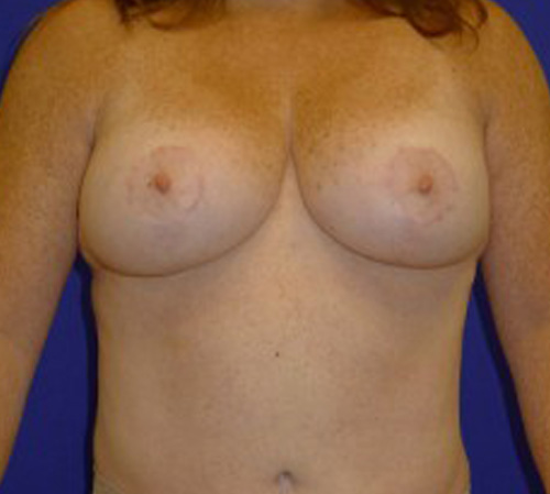 Lift Before and After | Plastic Surgery Institute of Washington