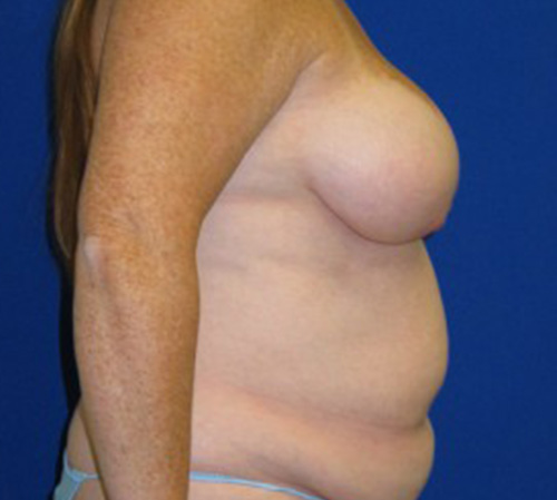 Lift Before and After | Plastic Surgery Institute of Washington