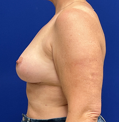 Lift Before and After | Plastic Surgery Institute of Washington