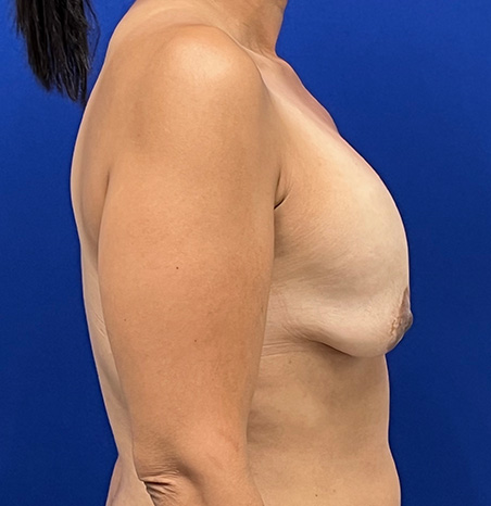 Lift Before and After | Plastic Surgery Institute of Washington