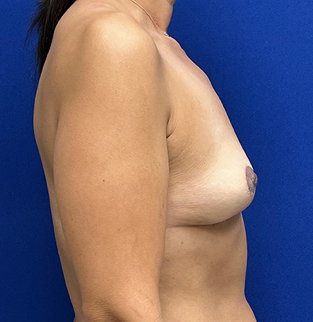Lift Before and After | Plastic Surgery Institute of Washington