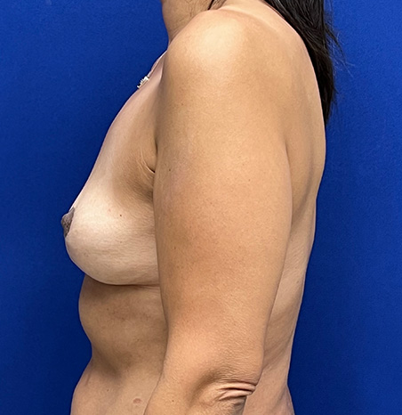 Lift Before and After | Plastic Surgery Institute of Washington