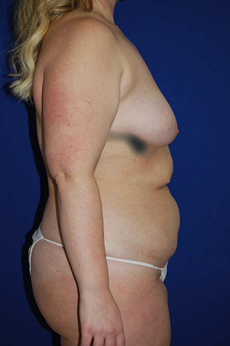 Lift Before and After | Plastic Surgery Institute of Washington