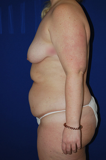 Lift Before and After | Plastic Surgery Institute of Washington