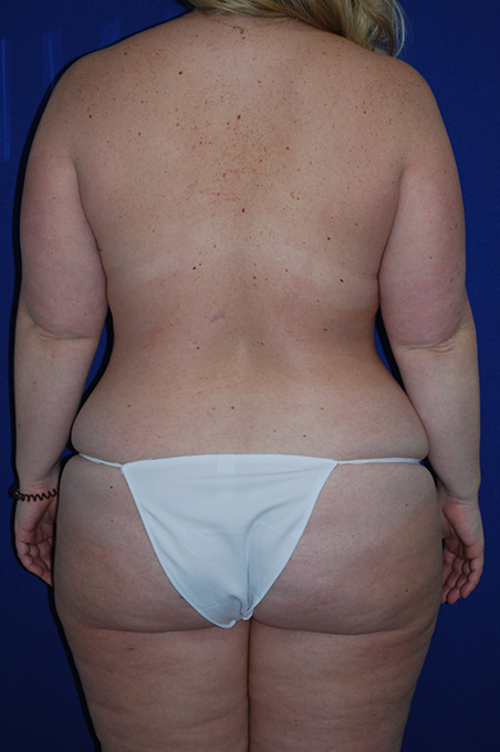 Lift Before and After | Plastic Surgery Institute of Washington