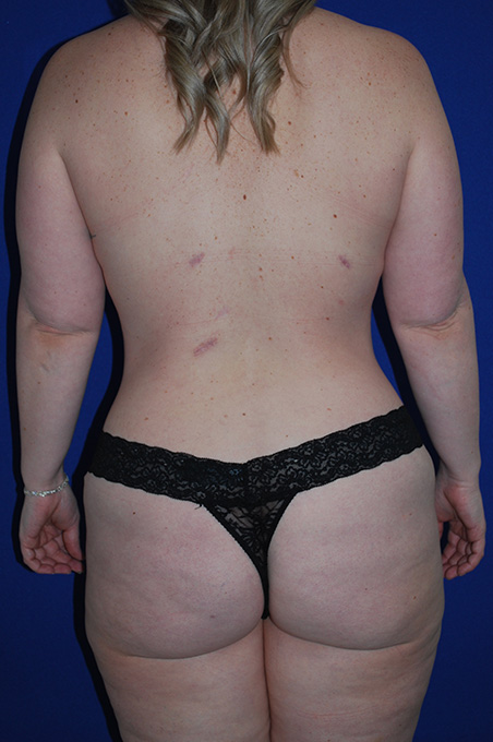 Lift Before and After | Plastic Surgery Institute of Washington