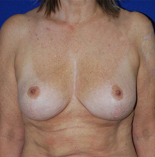 Lift Before and After | Plastic Surgery Institute of Washington