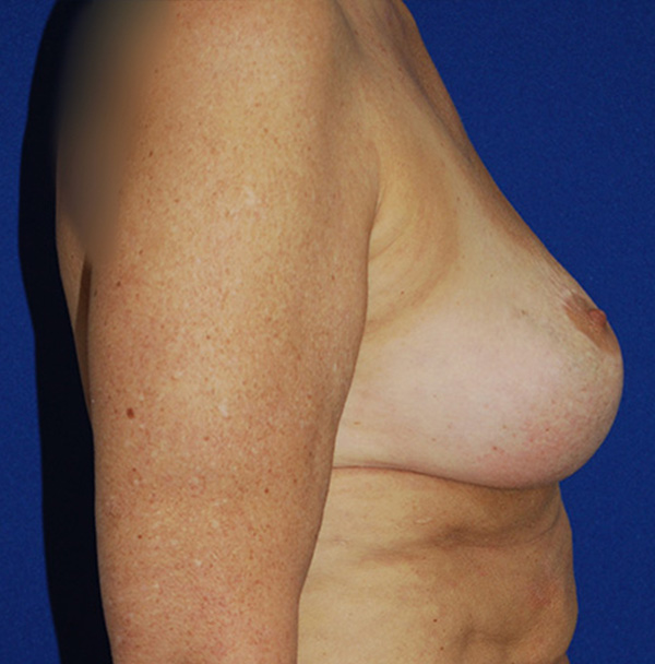 Lift Before and After | Plastic Surgery Institute of Washington