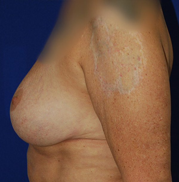Lift Before and After | Plastic Surgery Institute of Washington