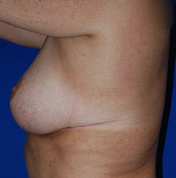 Lift Before and After | Plastic Surgery Institute of Washington