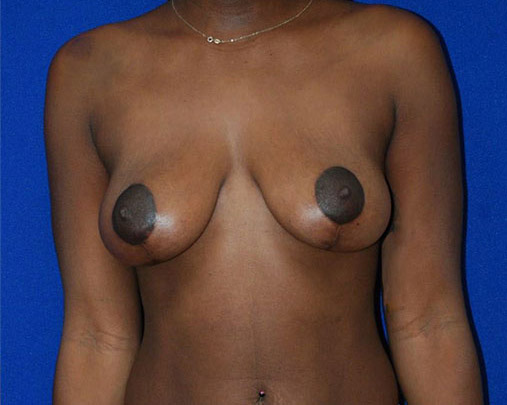 Lift Before and After | Plastic Surgery Institute of Washington