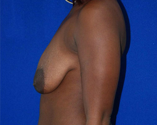 Lift Before and After | Plastic Surgery Institute of Washington