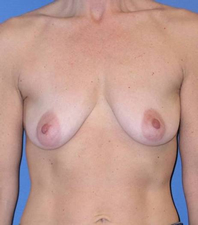 Lift Before and After | Plastic Surgery Institute of Washington