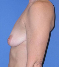 Lift Before and After | Plastic Surgery Institute of Washington