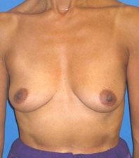 Lift Before and After | Plastic Surgery Institute of Washington