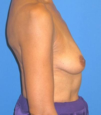 Lift Before and After | Plastic Surgery Institute of Washington