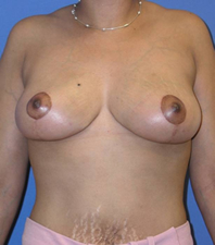 Lift Before and After | Plastic Surgery Institute of Washington