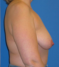 Lift Before and After | Plastic Surgery Institute of Washington