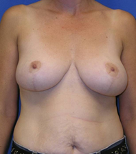 Lift Before and After | Plastic Surgery Institute of Washington