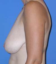 Lift Before and After | Plastic Surgery Institute of Washington