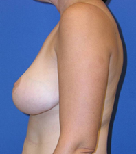 Lift Before and After | Plastic Surgery Institute of Washington