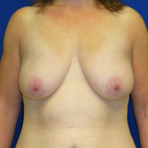 Lift Before and After | Plastic Surgery Institute of Washington