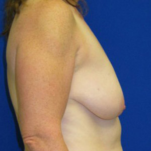 Lift Before and After | Plastic Surgery Institute of Washington