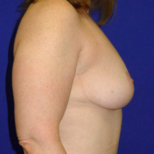 Lift Before and After | Plastic Surgery Institute of Washington