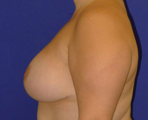 Lift Before and After | Plastic Surgery Institute of Washington