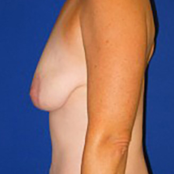 Lift Before and After | Plastic Surgery Institute of Washington