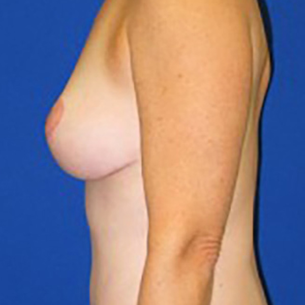 Lift Before and After | Plastic Surgery Institute of Washington