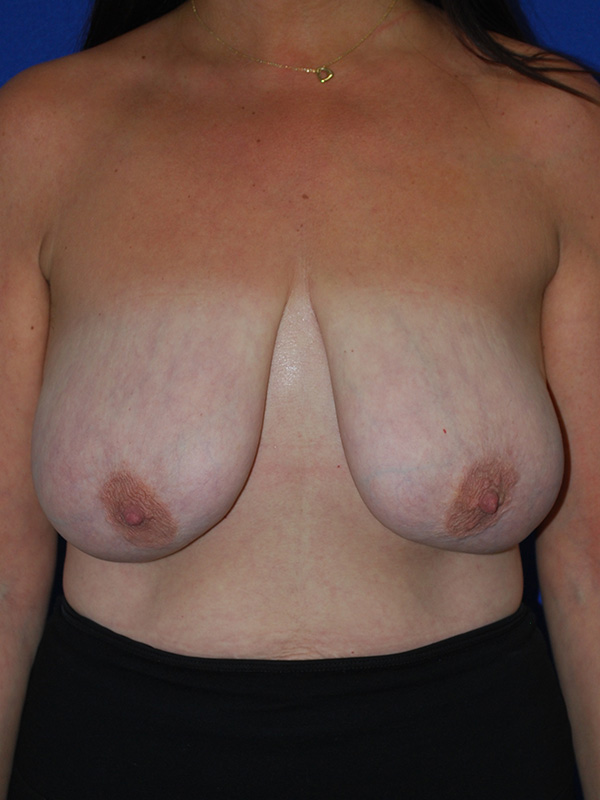 Lift Before and After | Plastic Surgery Institute of Washington