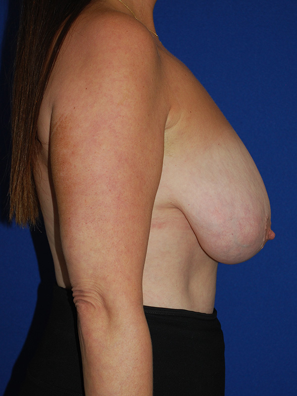 Lift Before and After | Plastic Surgery Institute of Washington