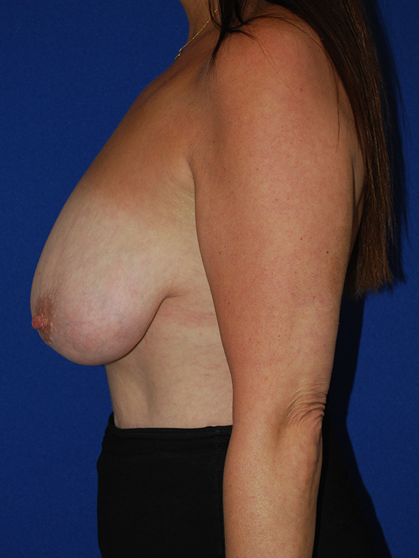 Lift Before and After | Plastic Surgery Institute of Washington